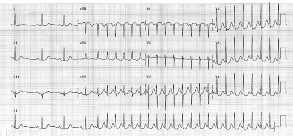 Palpitations after a MAZE Procedure - ECGpedia