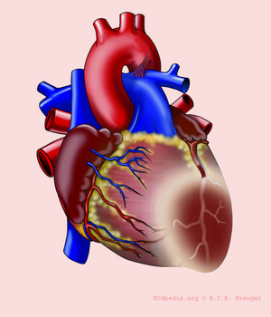 De-Heart with AL infarct.png