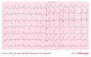 De Voogt ECG Archive - Intraventricular Conduction - ECGpedia