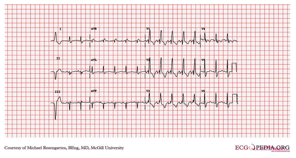 McGill Case 22 - ECGpedia