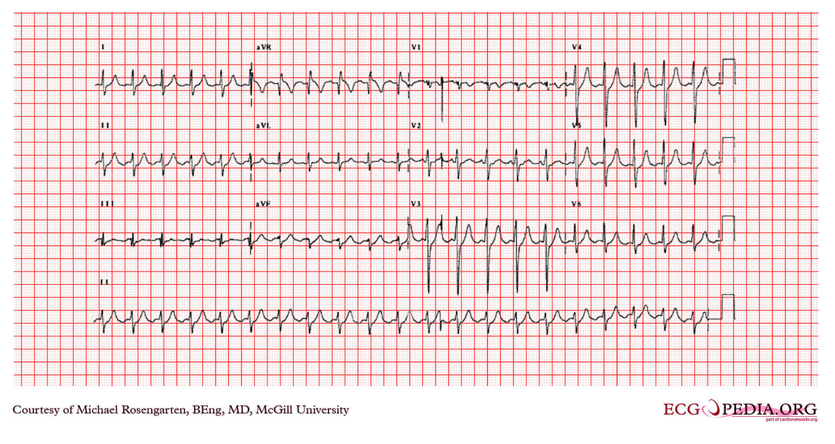 McGill Case 359 - ECGpedia