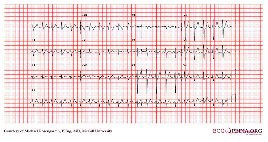 McGill Case 359 - ECGpedia