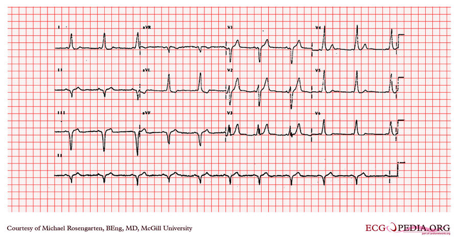 McGill Case 204 - ECGpedia