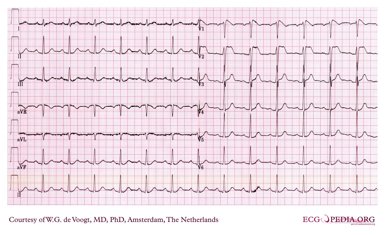 File:DVA0011.jpg - ECGpedia