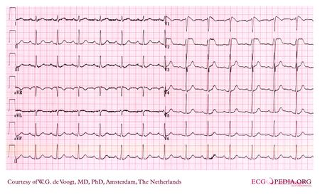 Example 24 - ECGpedia