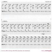 De Voogt ECG Archive - Pacemaker - ECGpedia