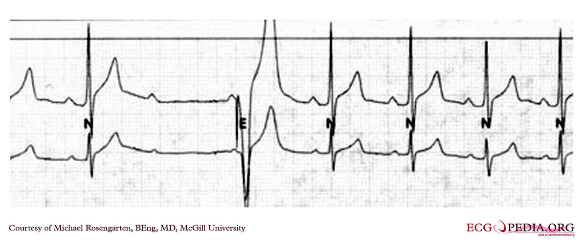 McGill Case 127 - ECGpedia