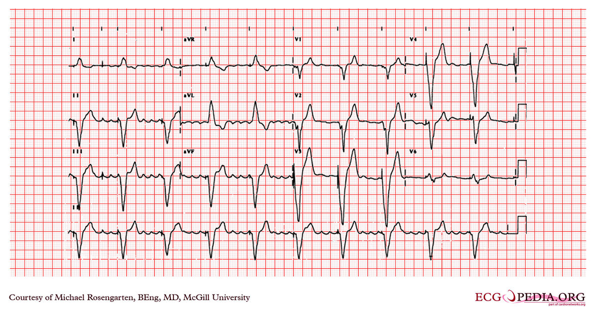 McGill Case 122 - ECGpedia