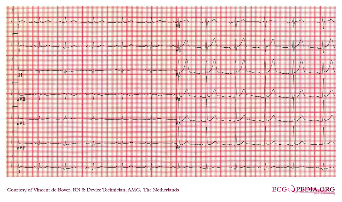 Amc Case 257 Ecgpedia