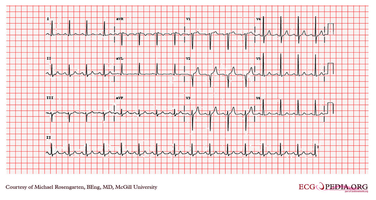 McGill Case 25 - ECGpedia