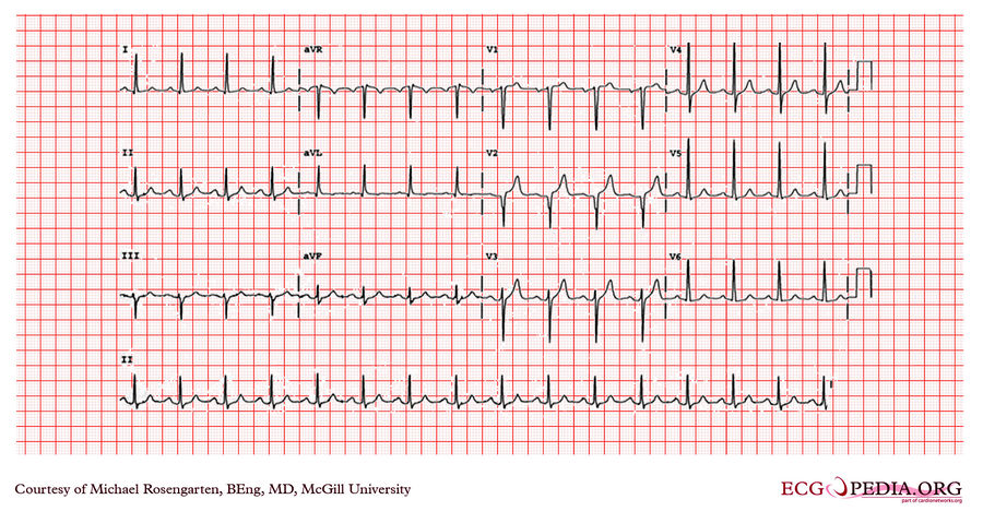 McGill Case 25 - ECGpedia