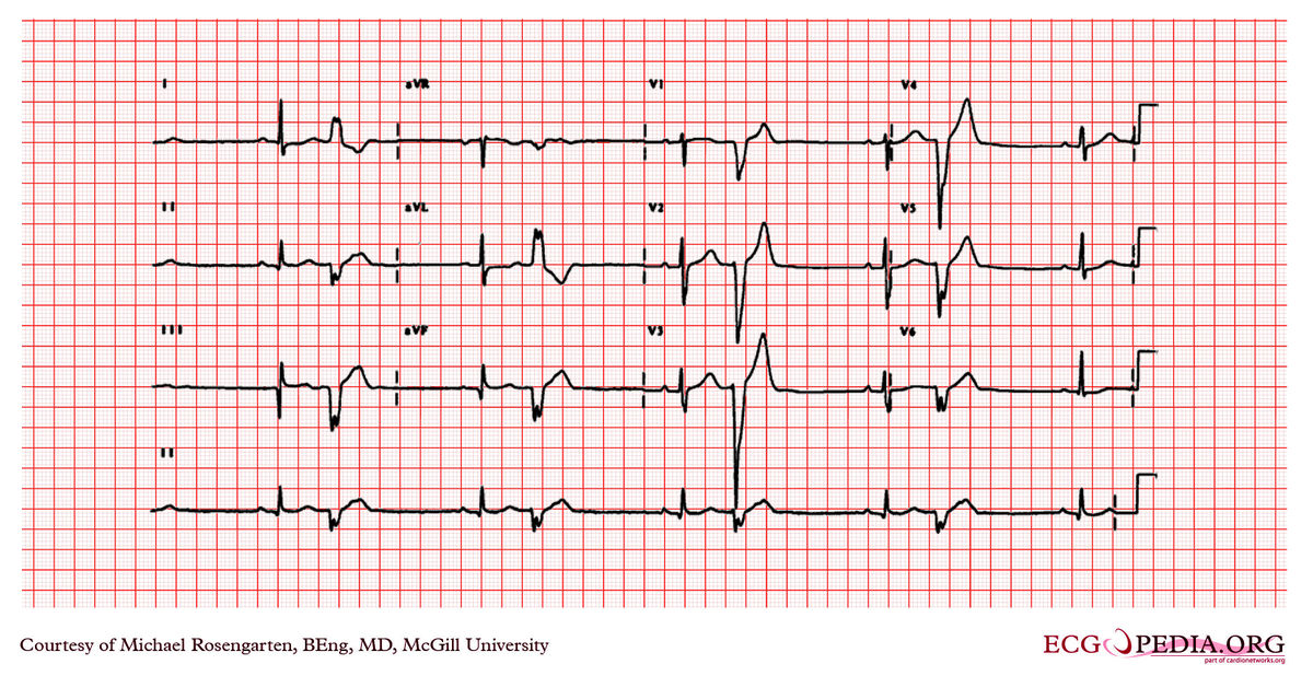 Mcgill Case 284 - Ecgpedia