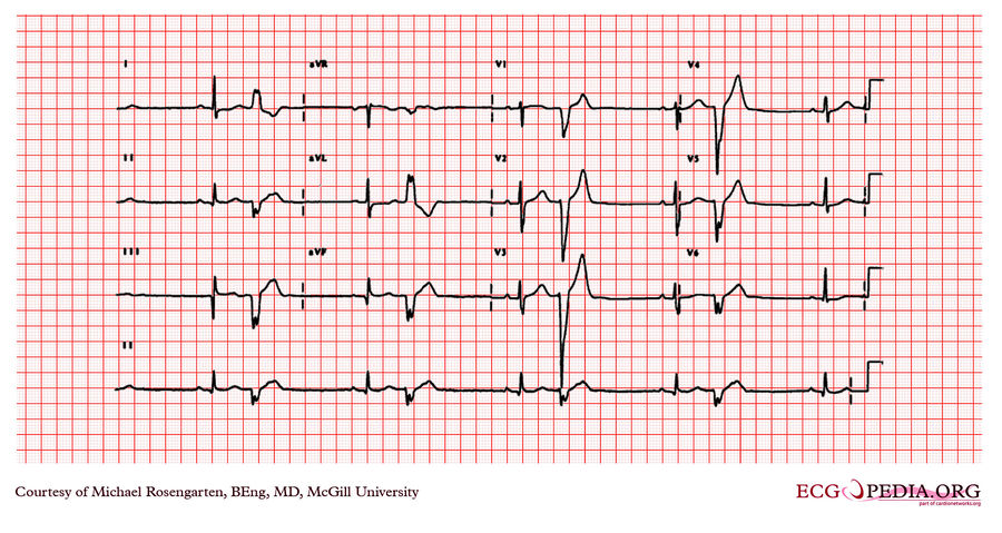 McGill Case 284 - ECGpedia