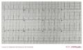 Same patient as above during sinus rhythm: evident delta wave