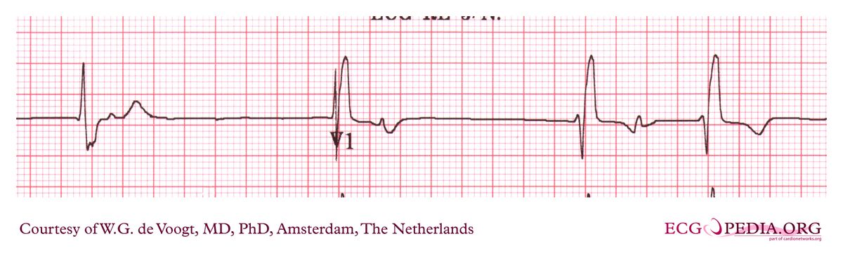 File:DVA0749.jpg - ECGpedia