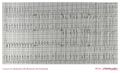 Atrial fibrillation in a patient with WPW: Fast Broad Irregular (FBI)