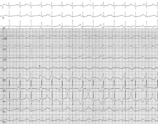 Abnormal Repolarization, Spot Diagnosis? - ECGpedia