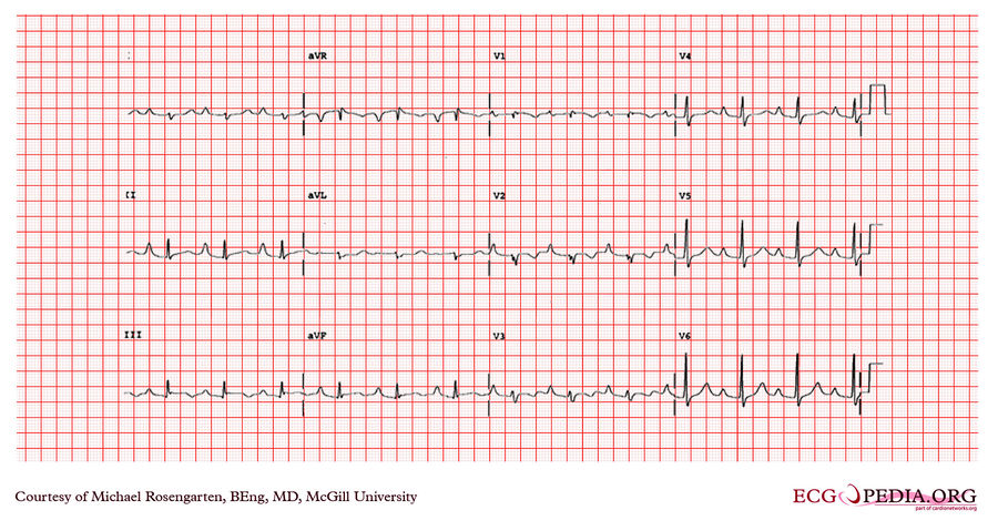 Mcgill Case 34 - Ecgpedia