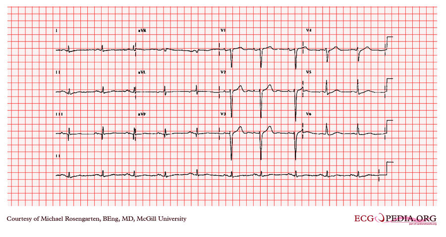 McGill Case 330 - ECGpedia