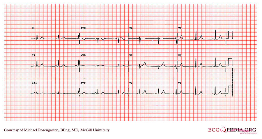 McGill Case 184 - ECGpedia