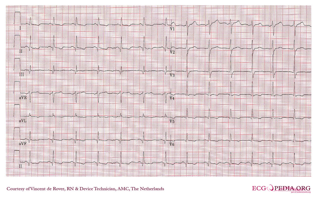 AMC Case 25 - ECGpedia