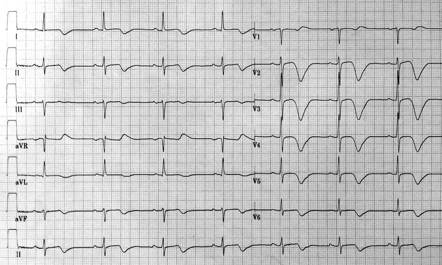 Answer - Case of the month (Nov-2012) - ECGpedia