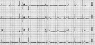 File:Puzzle 2006 08 268 fig2.jpg - ECGpedia