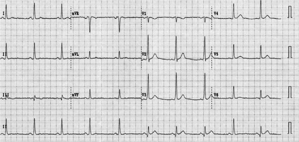 A Narrow QRS Complex Tachycardia Sensitive to Isoptin - ECGpedia