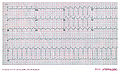 Another example of AV nodal re-entry tachycardia