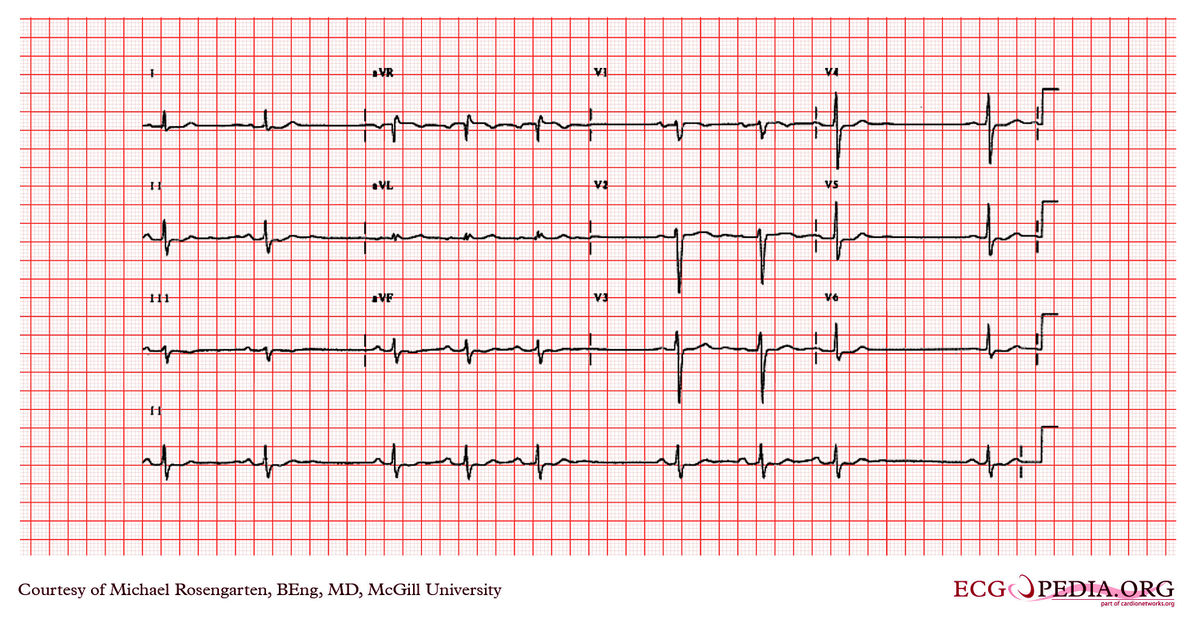 McGill Case 327 - ECGpedia