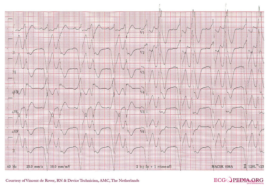 AMC Case 161 - ECGpedia