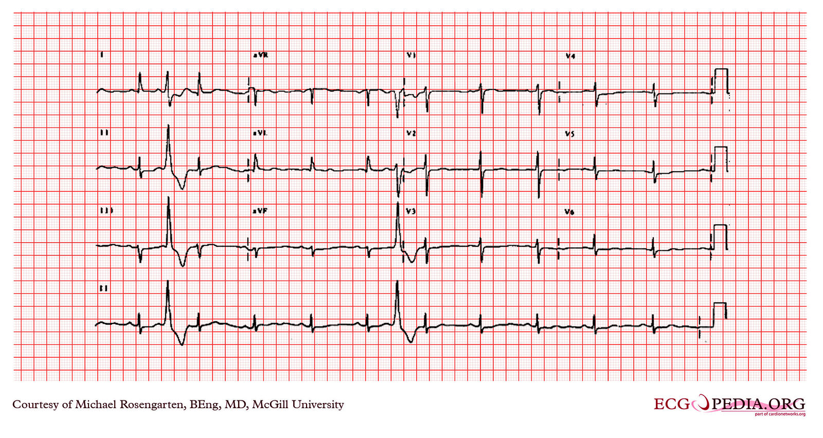 File:E251.jpg - ECGpedia