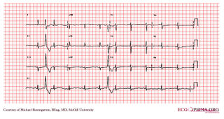 File:E251.jpg - ECGpedia