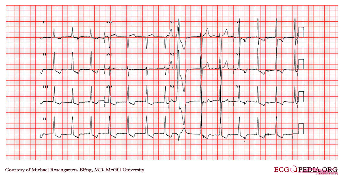 McGill Case 343 - ECGpedia