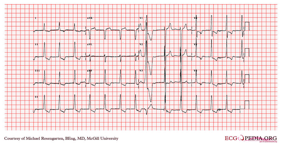 McGill Case 343 - ECGpedia