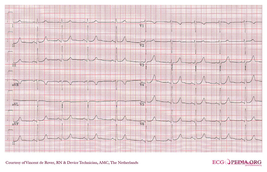 AMC Case 156 - ECGpedia