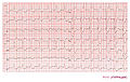 Case 3: Acute MI in a patient with LBBB