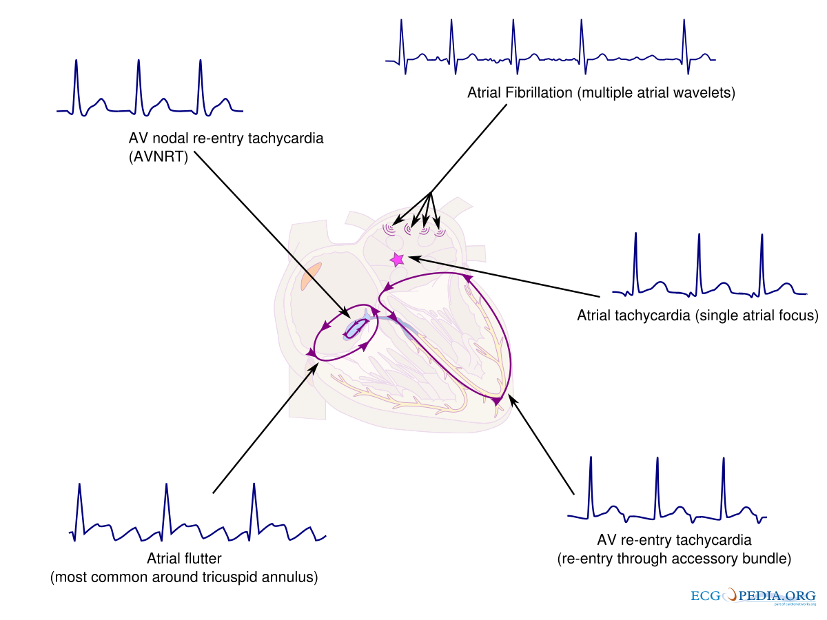 FileSVT overview.svg ECGpedia