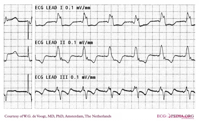 File:DVA0882.jpg - ECGpedia