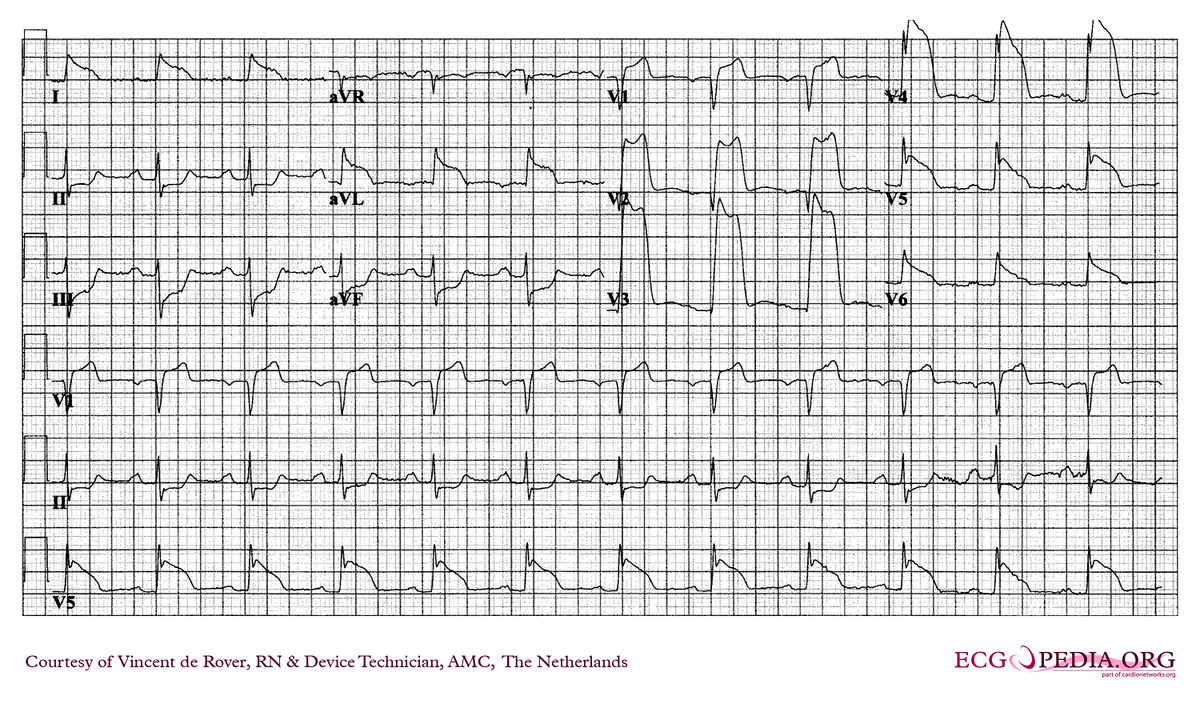 AMC Case 261 - ECGpedia