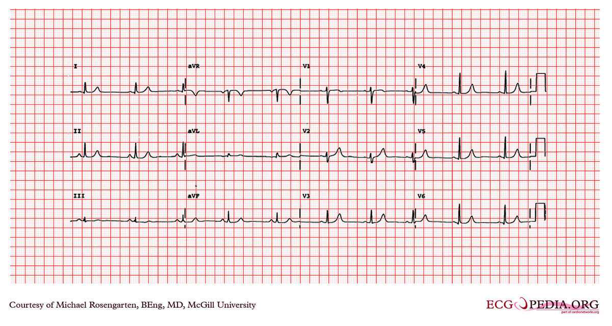 McGill Case 190 - ECGpedia