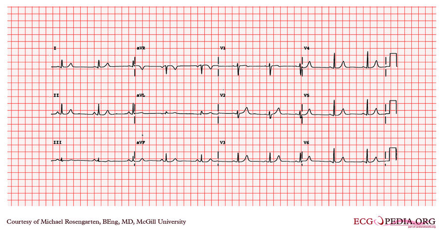 McGill Case 190 - ECGpedia