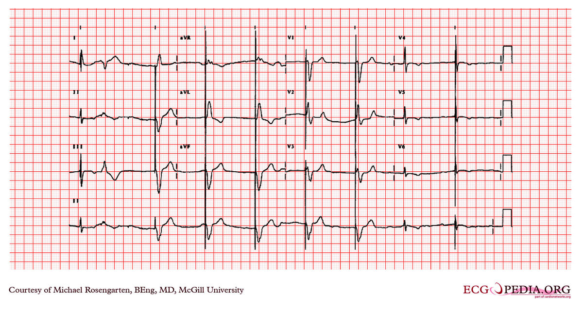 Mcgill Case 123 - Ecgpedia