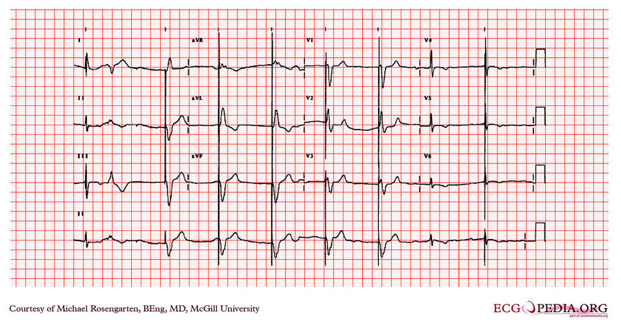 McGill Case 123 - ECGpedia