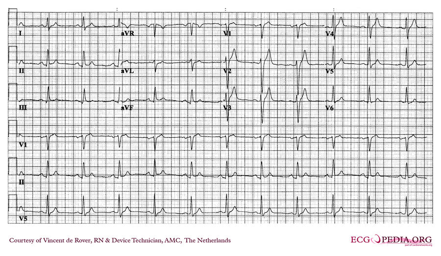 AMC Case 228 - ECGpedia