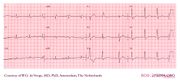 De Voogt ECG Archive - Intraventricular Conduction - ECGpedia