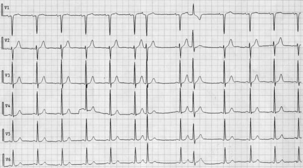 Wide Complexes Intervening Regular Sinus Rhythm - 3 - ECGpedia