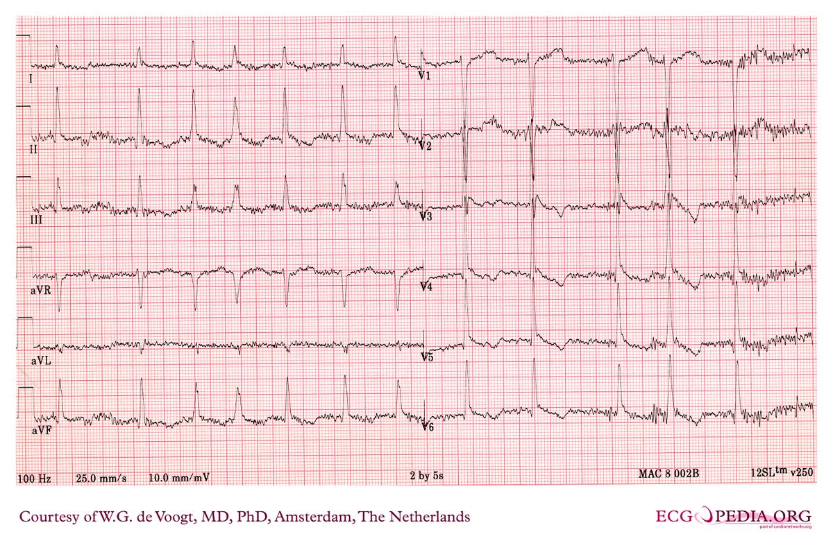 File:DVA0658.jpg - ECGpedia