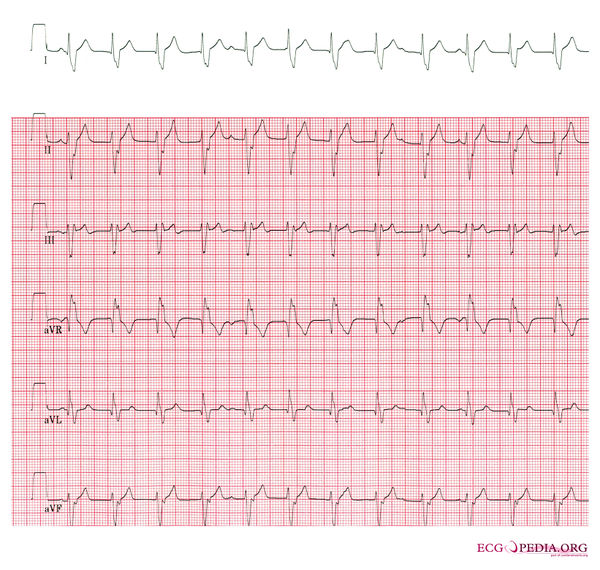 Example 26 - ECGpedia