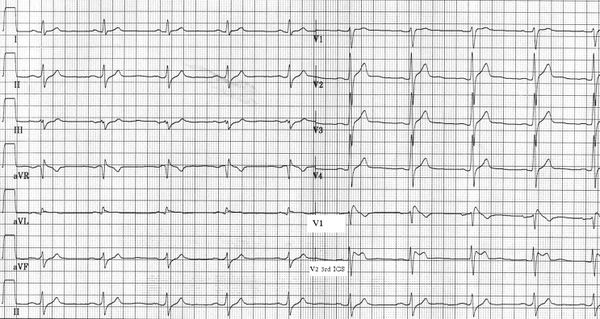 Puzzle 2006 1 33 - Answer - ECGpedia